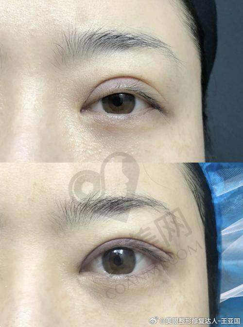 衡水唯美做双眼皮，技术实力如何？