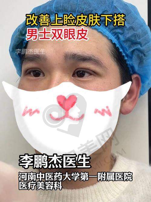 杭州艺星双眼皮 + 开眼角术后修复情况如何？