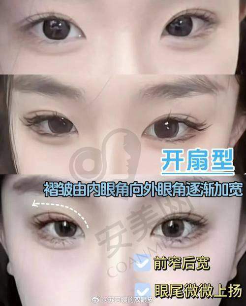 为什么选择武汉五洲严飞医生做双眼皮手术？