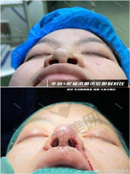 幼态鼻整形后能达到怎样的成效？