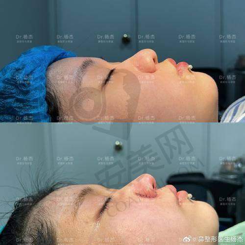杭州艺星幼态鼻整形价格是如何确定的？
