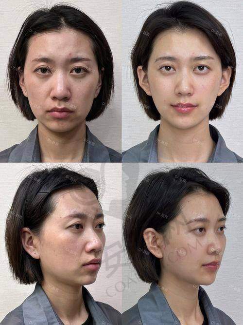 北京圣嘉新医疗美容医院磨骨的口碑如何？