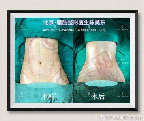 选择重庆军科吸脂，选择美丽与自信