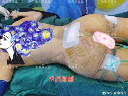 重庆军科医院腰腹环吸适合哪些人群？