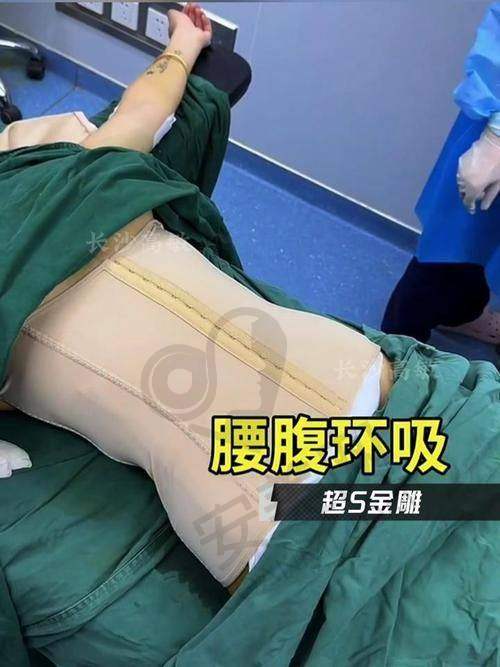 重庆军科医院腰腹环吸术后成效如何？