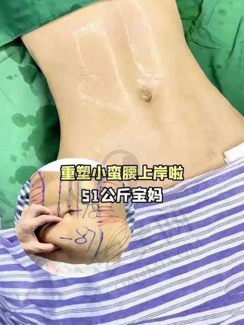 重庆军科医院腰腹环吸技术有何独特之处？