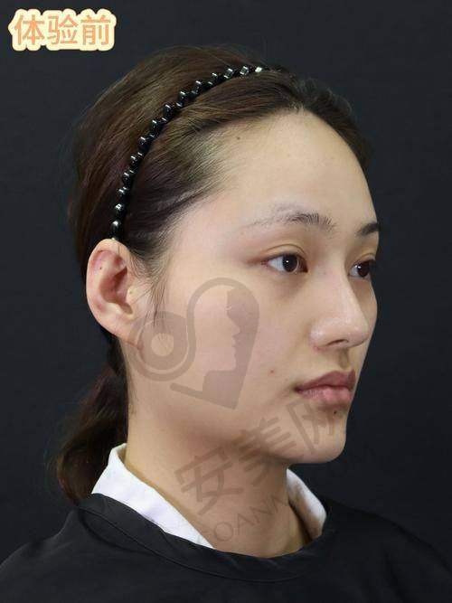 与其他下颌角整形方法相比，磨骨手术有什么特点？