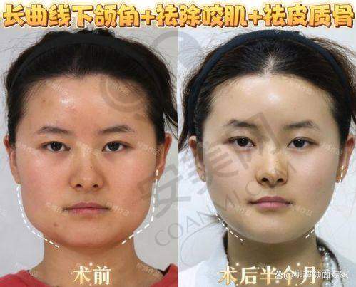 术后修复需要注意什么？