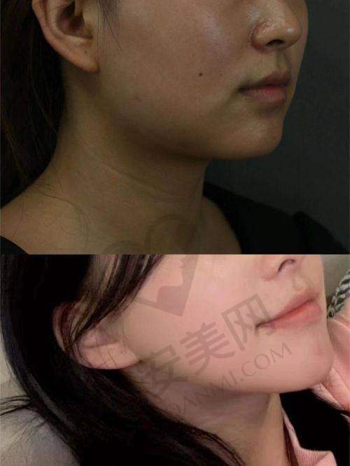 下颌角磨骨手术有风险吗？如何降低风险？