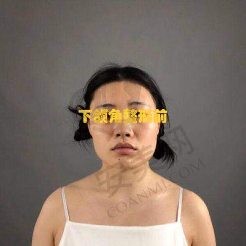 下颌角磨骨手术的原理是什么？