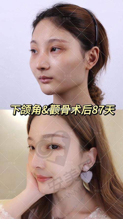 下颌角磨骨手术适合哪些人群？