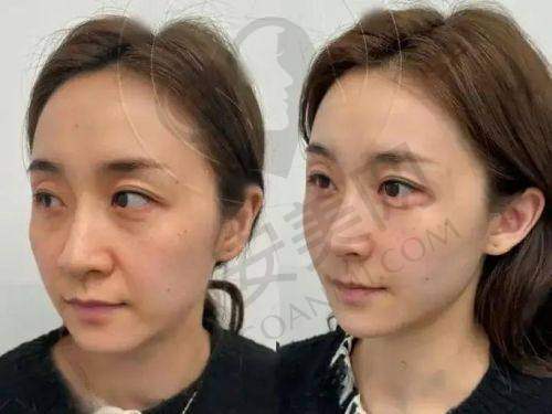 如何预约李俊霞医生面诊及幼态脸注射
