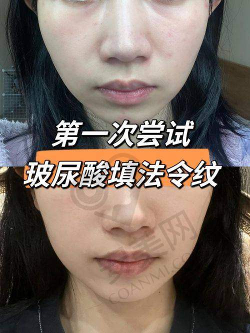 郑州壹加壹玻尿酸除皱的优势有哪些？