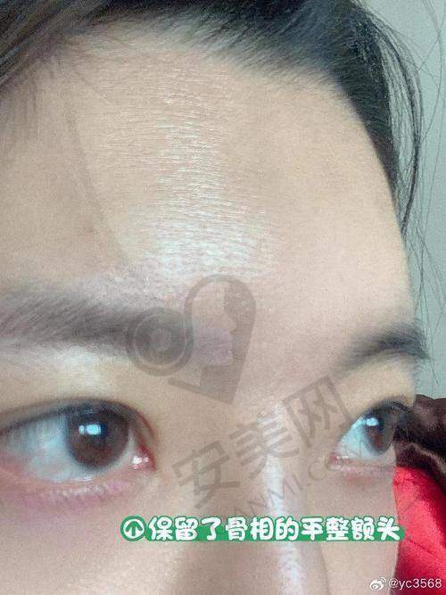 郑州壹加壹玻尿酸除皱的成效能维持多久？