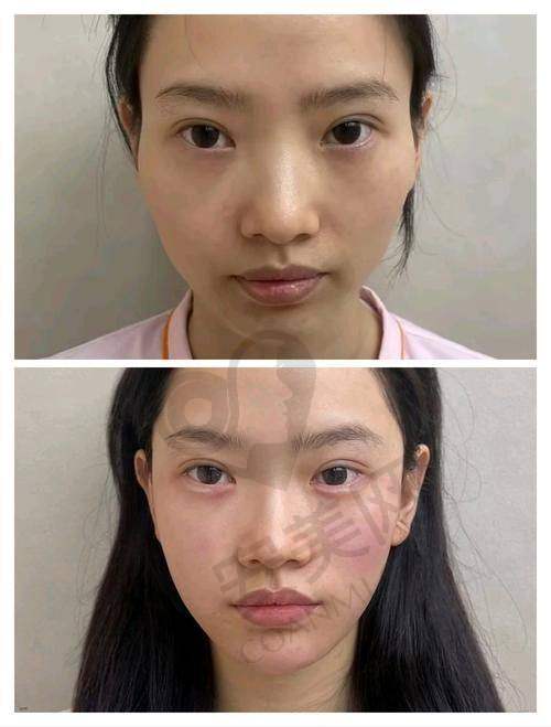 什么是玻尿酸除皱？