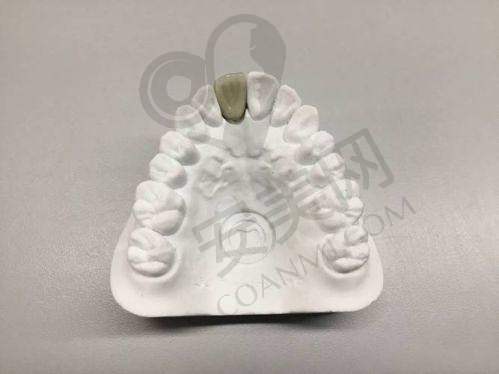 徐州牙知道口腔烤瓷冠修复的价格是如何划分的？