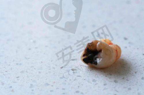 呼和浩特华医口腔医院与其他医院相比，龋齿拔牙费用有优势吗？