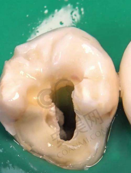 在呼和浩特华医口腔医院拔牙后还会有其他费用产生吗？