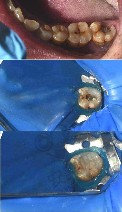 总结：呼和浩特华医口腔医院根管治疗值得推荐吗？