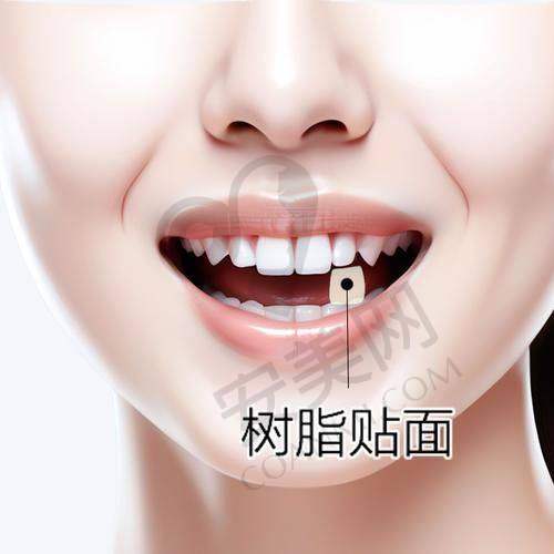 做国产牙齿瓷贴面美白有哪些注意事项？