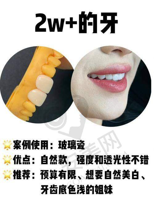 什么是树脂贴面美白？