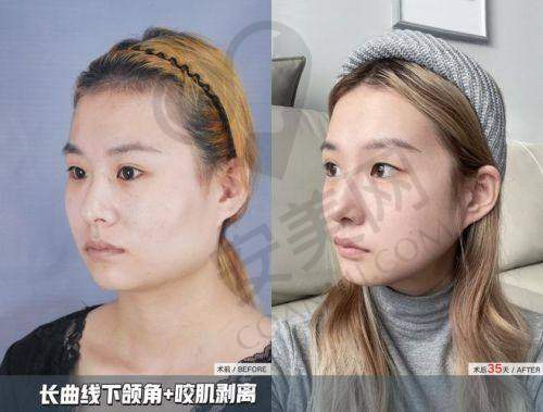 下颌角磨骨手术的成效能维持多久？