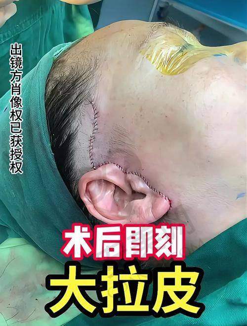 面部小切口拉皮技术的特色在哪里？