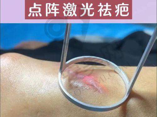 上海虹桥医院烫伤疤痕修复价格是如何确定的？