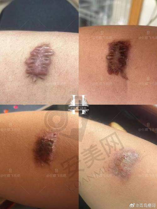 如何判断上海虹桥医院疤痕科的收费是否合理？