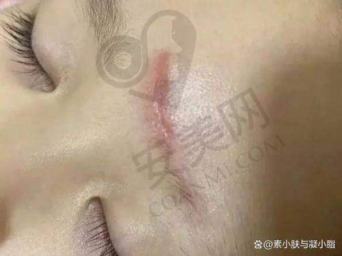 上海虹桥医院疤痕科的资质如何影响收费？