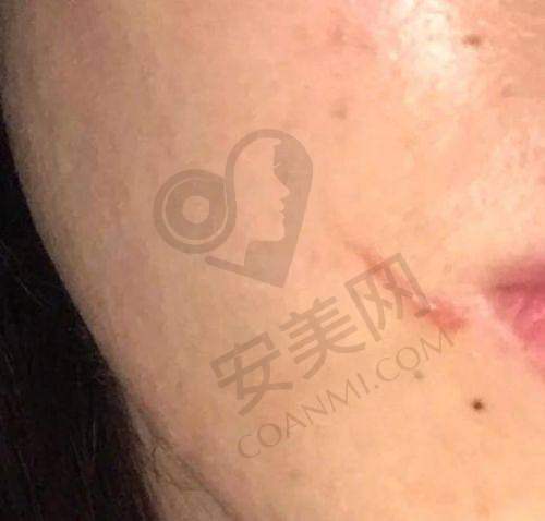 上海虹桥医院疤痕科有哪些收费优惠政策？