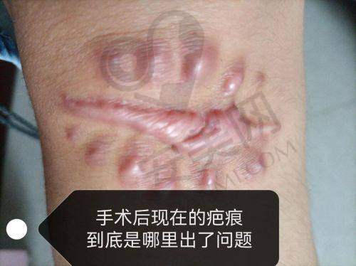 如何选择适合自己的烫伤疤痕修复医院？