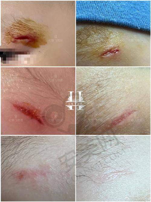 上海虹桥医院疤痕科的服务质量与收费有什么关系？