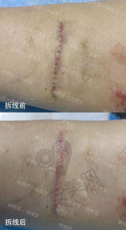 口碑评价：成都军建疤痕医院的患者评价怎么样？