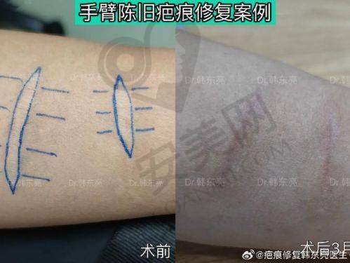 收费标准：成都军建疤痕医院的收费是否合理？