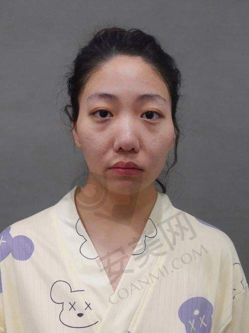什么是面部脂肪填充？