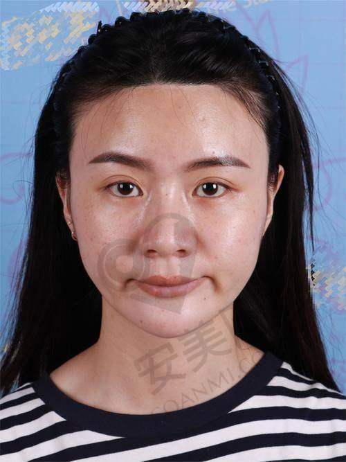 面部脂肪填充适合哪些人群？
