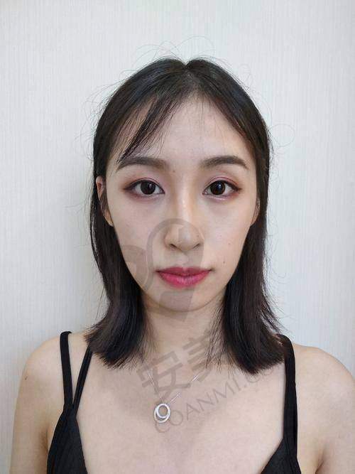 太原军大面部脂肪填充有哪些优势？