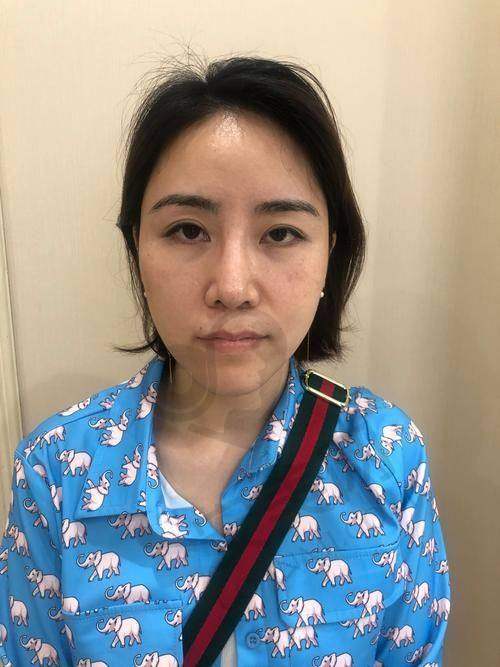 选择太原军大进行面部脂肪填充有保护吗？