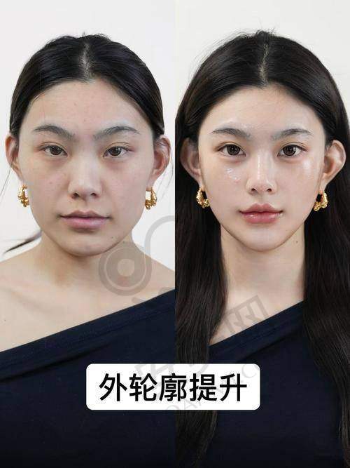 什么是北京圣嘉新张笑天面部轮廓三件套？