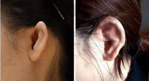 选择大连雅婷医院双眼皮整形有哪些优势？