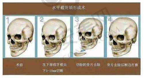 西安奥美定取出技术好的医院——西安国际医学整形医院