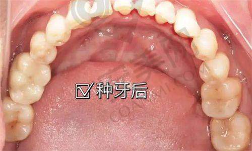 种植牙的流程是怎样的？