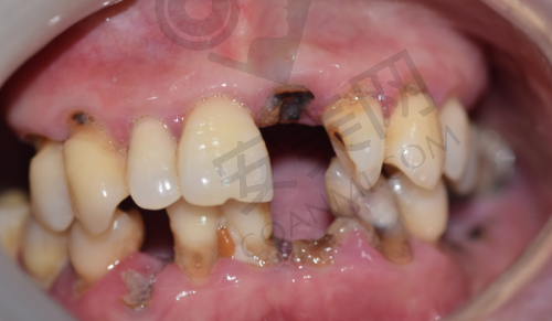 与其他口腔医院相比，内江医大口腔科的威尔植体 + 基台 + 烤瓷冠套餐有什么独特之处？