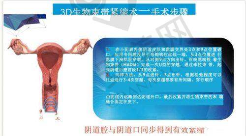 济南丽合医院的医生团队在玻尿酸注射方面水平如何？