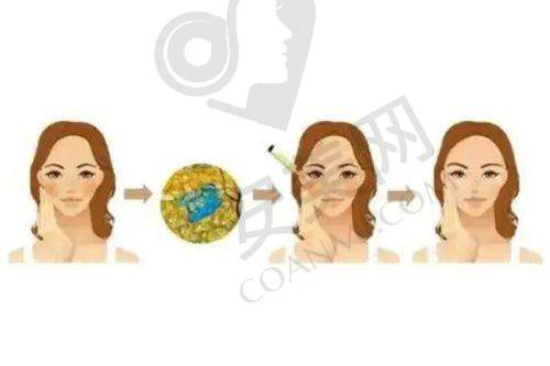 深圳鹏程医院玻尿酸填充鼻基底的价格是如何确定的？