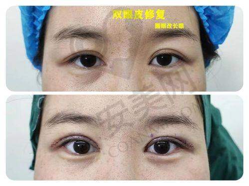 林建新医生做双眼皮修复的临床经验多吗？