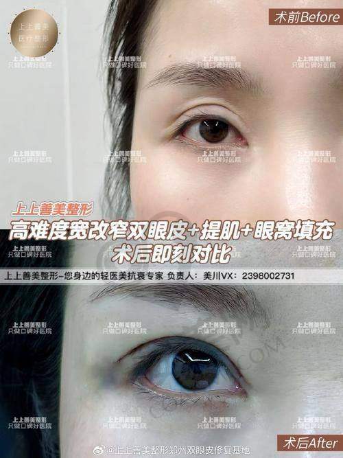患者对林建新医生双眼皮修复的评价如何？
