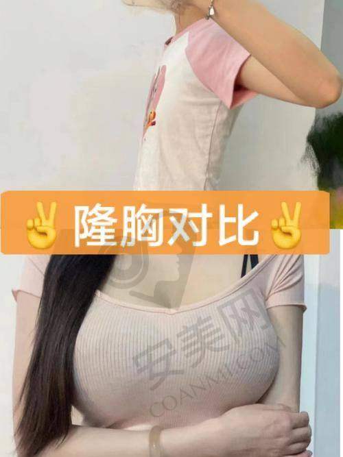 赣州亚韩吴礼诚医生降胸技术怎么样？
