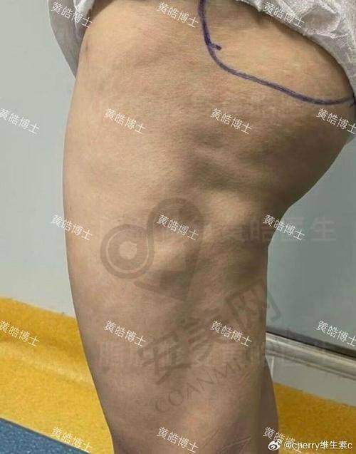 腰腹 + 大腿吸脂有哪些优势？